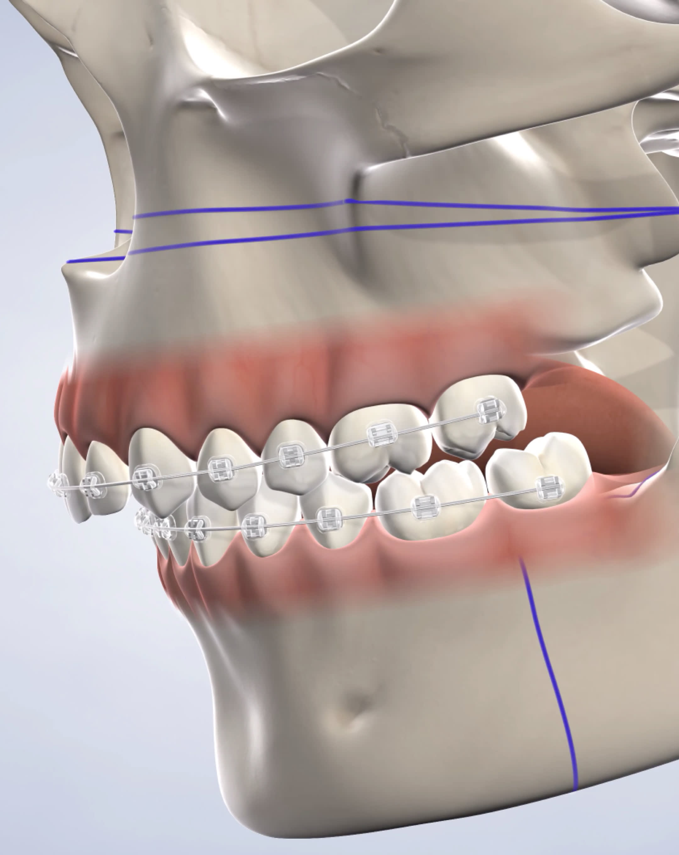 Jaw surgery in Houston, TX