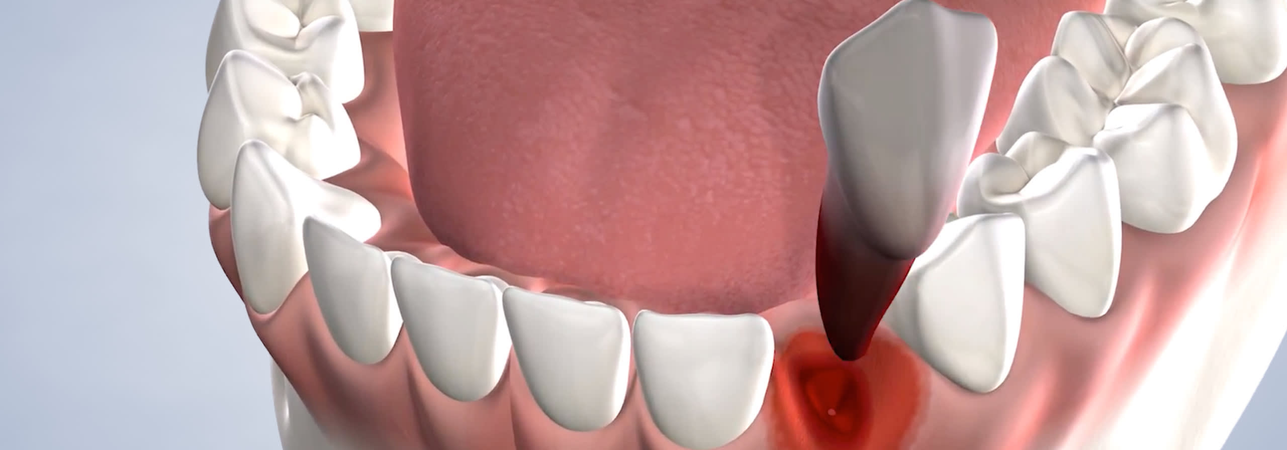 Tooth extractions in Houston, TX