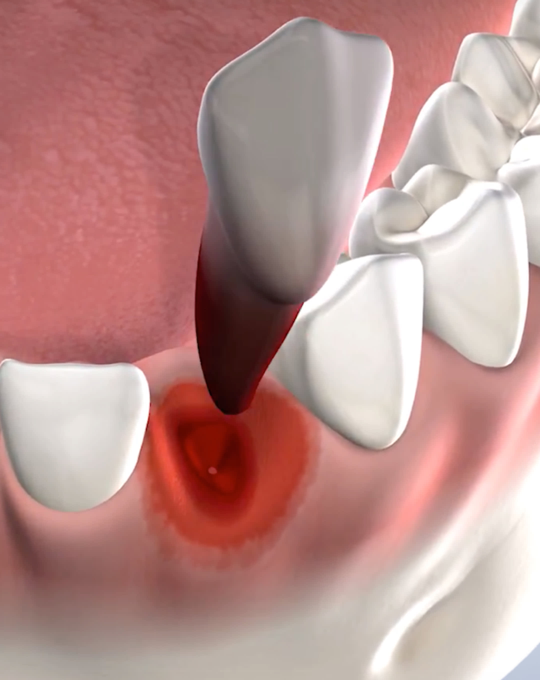 Tooth extractions in Houston, TX